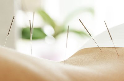 03_Therapie_500x330 Akupunktur