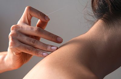 04_Therapie_500x330 Akupunktur
